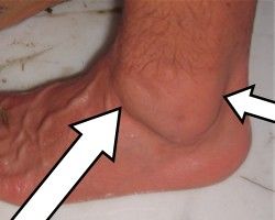 physiotherapy at home charges